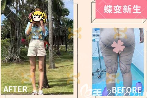 丁硯江醫(yī)生腿部吸脂失敗修復(fù)案例