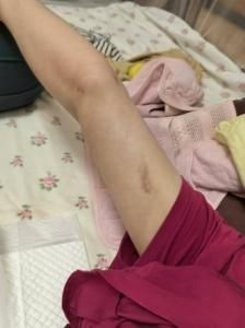 抽脂術將林女士的右臂扎穿。　　受訪者供圖