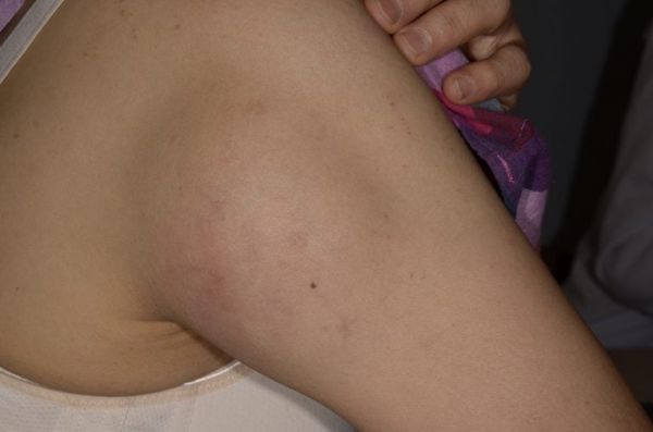 脂肪瘤手術費用