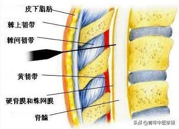 穴位注射就是封闭针？关键看成分