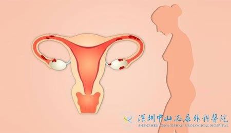 巧克力囊腫