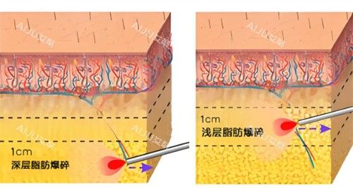 激光溶脂作用皮膚層圖