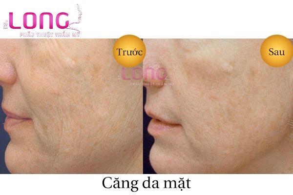 Can-da-mat-khong-phau-thuat-co-understand-through-khong-1