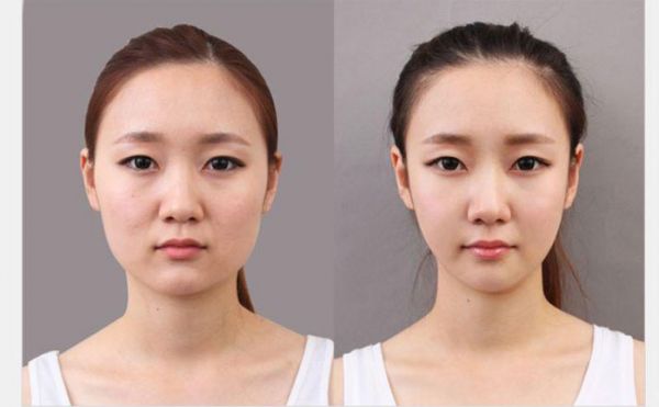 非手術(shù)瘦臉多少錢？非手術(shù)瘦臉方法有哪些？