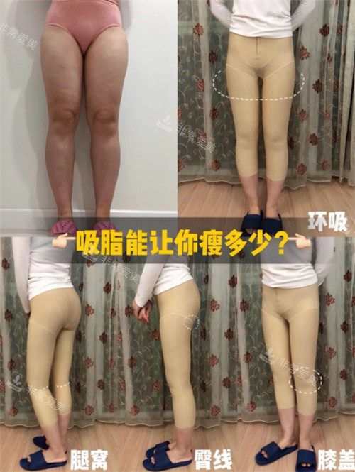 腿部吸脂手術(shù)圖