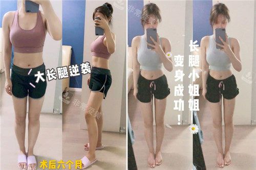 吸脂術(shù)后恢復(fù)照