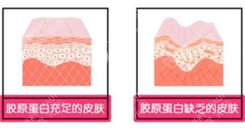 膠原蛋白填充的皮膚對(duì)比