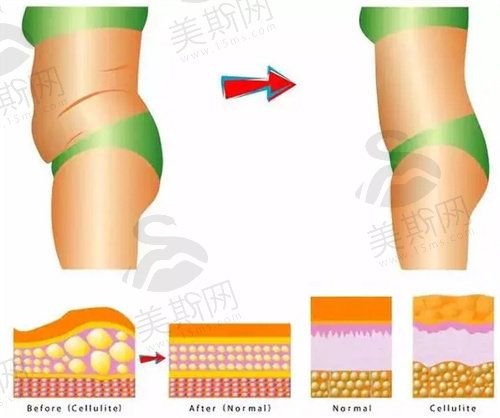 負(fù)壓吸脂和水動(dòng)力吸脂哪個(gè)好