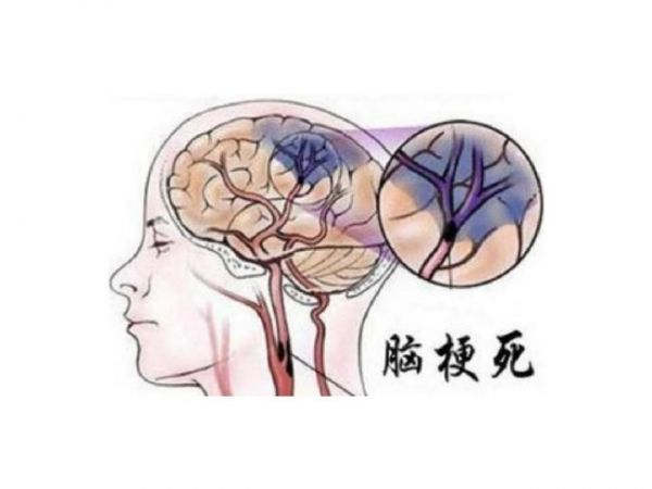 脑梗死是什么意思 能治愈吗？