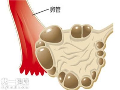 多囊卵巢能懷孕嗎 建議在醫(yī)生指導(dǎo)下進(jìn)行