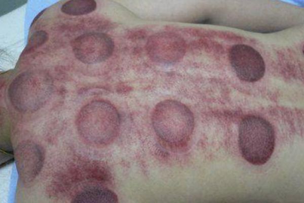 女人背部拔罐位置圖
