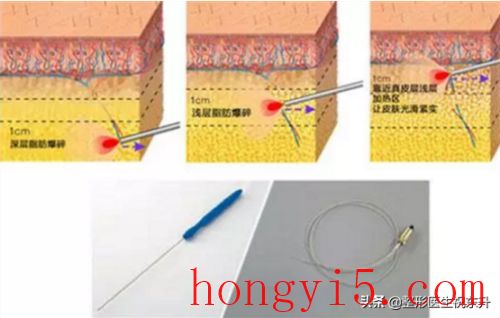 激光溶脂的危害(激光溶脂危害有哪些)插圖3