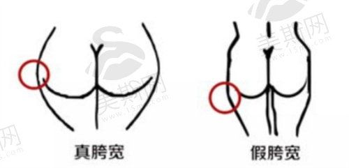 溶脂去妈妈臀价格