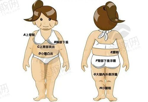 溶脂去妈妈臀的优缺点