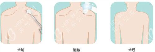 超聲溶脂術前術后對比圖