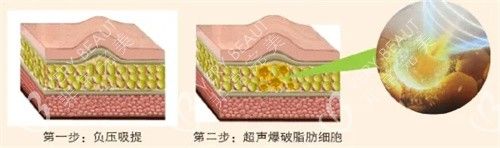 超聲溶脂皮下脂肪變化圖