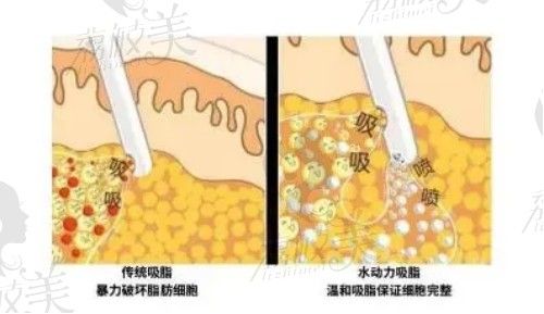 溶脂 針好還是吸脂好?