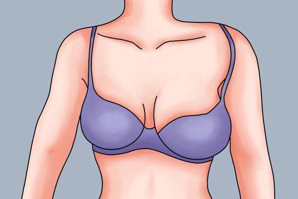 乳房不对称图