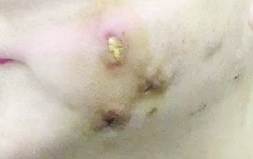 注射溶脂后面部出现腐烂情况