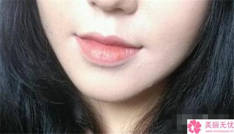 玉林華美美容整形醫(yī)院專家介紹溶脂減下巴指南