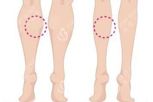 小腿肌肉消除卡通对比图