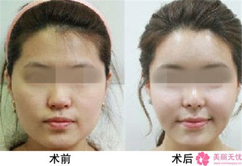 面部輪廓微對(duì)身體有怎樣的危害