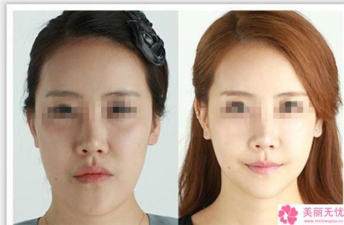 臉部輪廓整形的效果及安全性怎么樣