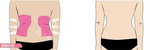 腰腹吸脂前后對(duì)比