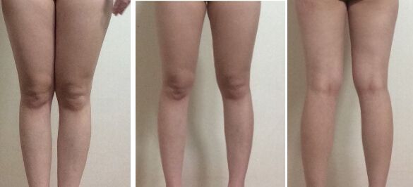大腿肥胖怎么辦