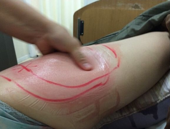 做完冷凍溶脂后大腿的樣子
