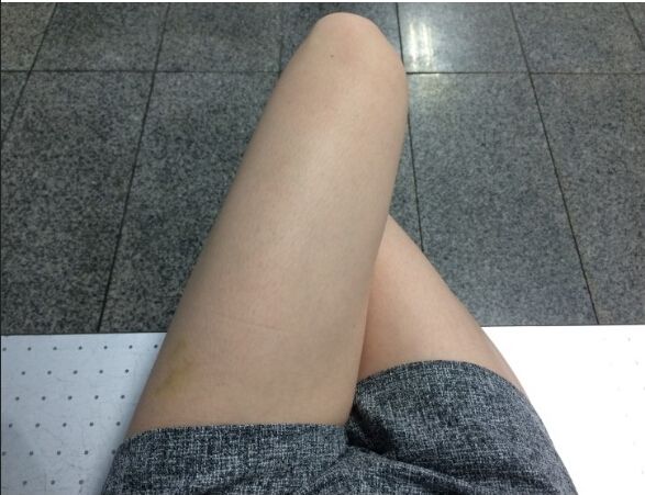 做冷凍溶脂術(shù)后對比圖