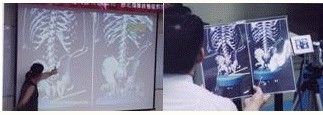 力學(xué)療法：脊椎側(cè)彎矯正法
