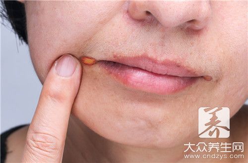 唇炎用哪種膏藥好的快
