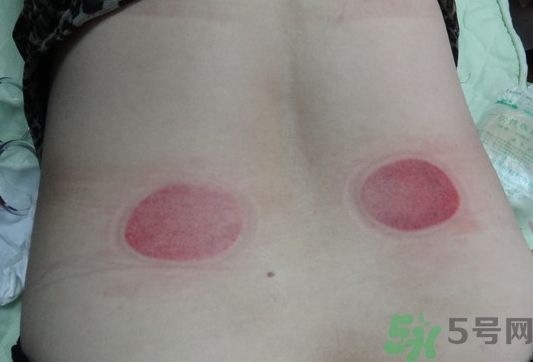 拔火罐可以減肥嗎?拔火罐能減肥嗎?