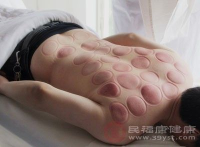 拔火罐注意，紫印未消失不宜重復(fù)拔