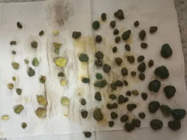 我用苹果醋（汁）进行肝胆排石法的经历（2）