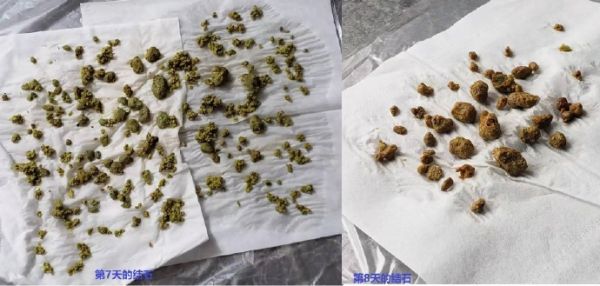 我用苹果醋（汁）进行肝胆排石法的经历（2）