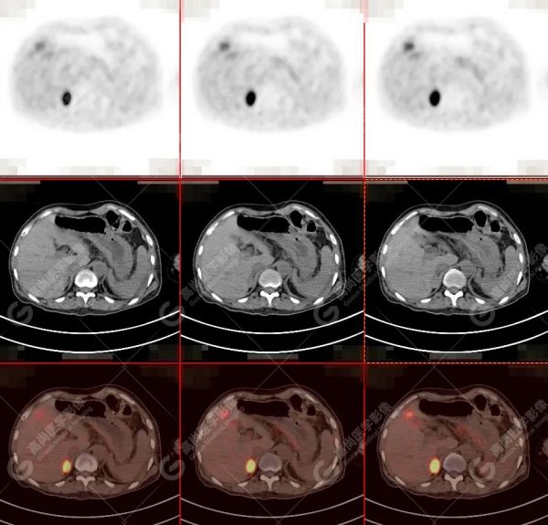 18F-DOPA PET/CT 显像诊断嗜铬细胞瘤一例