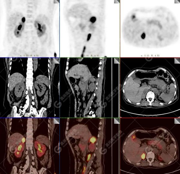 18F-DOPA PET/CT 显像诊断嗜铬细胞瘤一例