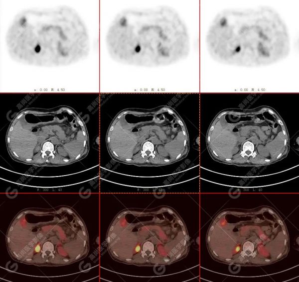 18F-DOPA PET/CT 显像诊断嗜铬细胞瘤一例