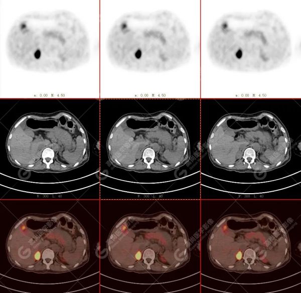 18F-DOPA PET/CT 显像诊断嗜铬细胞瘤一例