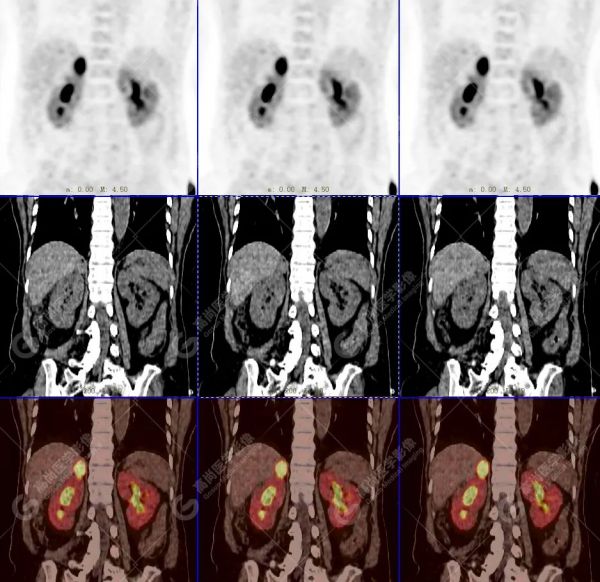 18F-DOPA PET/CT 显像诊断嗜铬细胞瘤一例