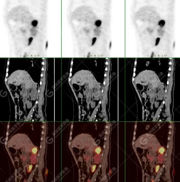 18F-DOPA PET/CT 显像诊断嗜铬细胞瘤一例