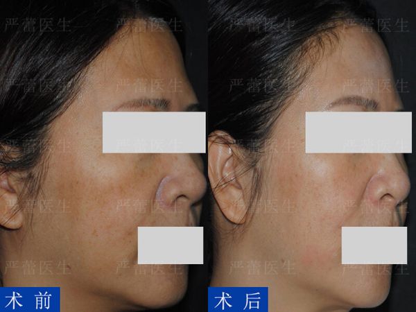 6非炎性黄褐斑-微针治疗医生水印.jpg