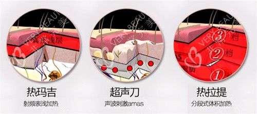面部提升項(xiàng)目對比
