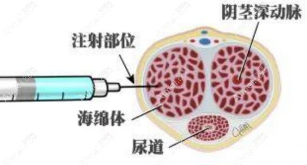 国内男性玻尿酸注射增大增粗好的医院排名:重庆星荣/成都九龙等上榜做阴茎增大增粗好
