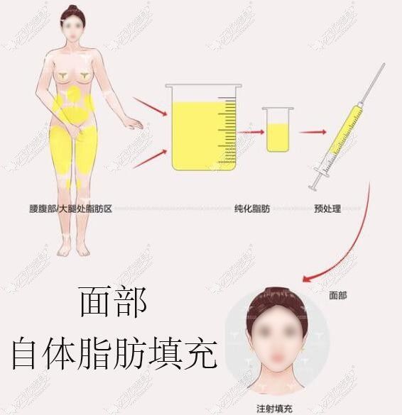 我找王明利做了全面部脂肪填充,親身經(jīng)歷收費不高臉不變大