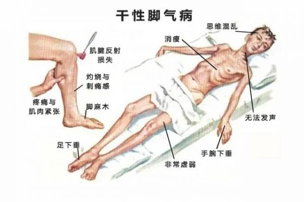 维生素B1缺乏和“脚气病”