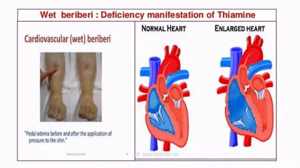 维生素B1缺乏和“脚气病”
