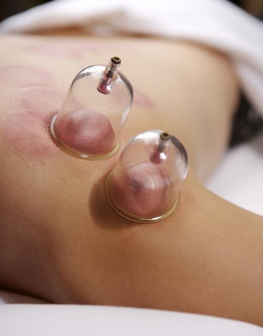 拔火罐疏通经络消肿止痛 过于频繁拔罐不利健康